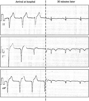 Case Report: A First Case of Spontaneous Coronary Artery Dissection Potentially Associated With Scuba Diving